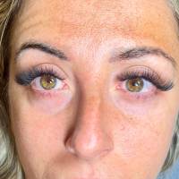 Notre zone d'activité pour ce service Tarifs soin visage photorajeunissement microneedling